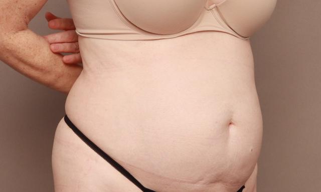 Mini Tummy Tuck before at O'Neill Plastic Surgery in Charleston, SC