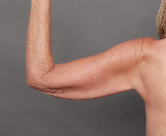 CoolSculpting before at O'Neill Plastic Surgery in Charleston, SC