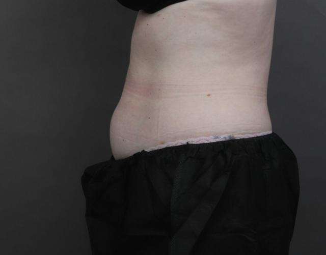 Liposuction before at O'Neill Plastic Surgery in Charleston, SC