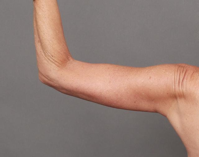 CoolSculpting after at O'Neill Plastic Surgery in Charleston, SC