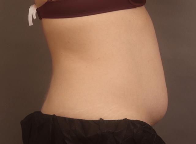 Liposuction before at O'Neill Plastic Surgery in Charleston, SC