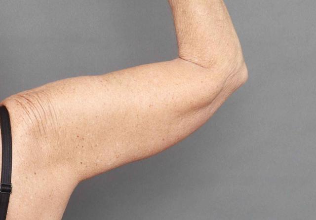 CoolSculpting after at O'Neill Plastic Surgery in Charleston, SC
