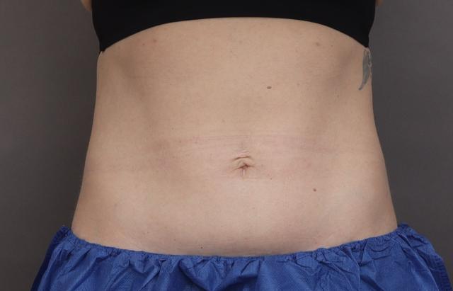Liposuction after at O'Neill Plastic Surgery in Charleston, SC