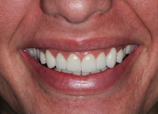 La Jolla Cosmetic Dentistry and Orthodontics invisalign after — San Diego, CA