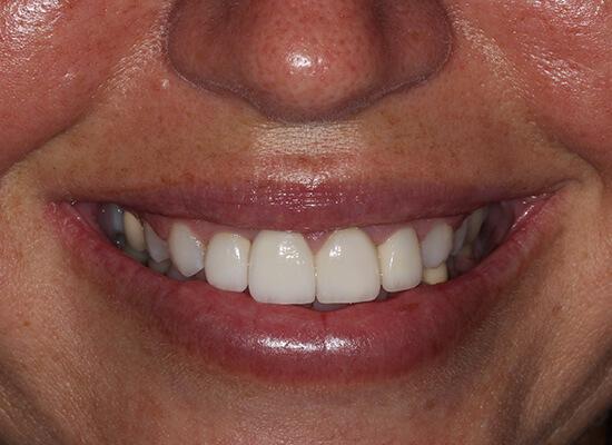 La Jolla Cosmetic Dentistry and Orthodontics invisalign after — San Diego, CA
