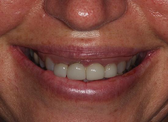 Invisalign before at La Jolla Cosmetic Dentistry and Orthodontics in San Diego, CA