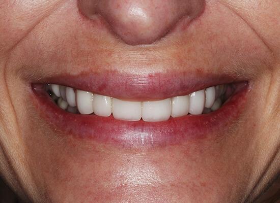 La Jolla Cosmetic Dentistry and Orthodontics invisalign after — San Diego, CA