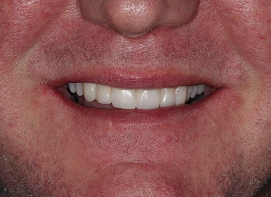 La Jolla Cosmetic Dentistry and Orthodontics invisalign after — San Diego, CA