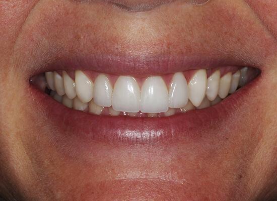 La Jolla Cosmetic Dentistry and Orthodontics invisalign after — San Diego, CA