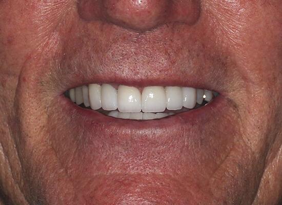 La Jolla Cosmetic Dentistry and Orthodontics invisalign after — San Diego, CA