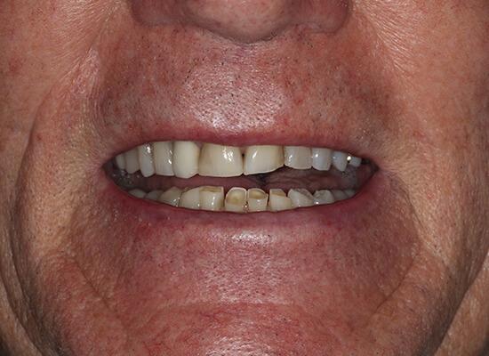 Invisalign before at La Jolla Cosmetic Dentistry and Orthodontics in San Diego, CA