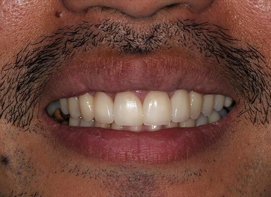 La Jolla Cosmetic Dentistry and Orthodontics invisalign after — San Diego, CA