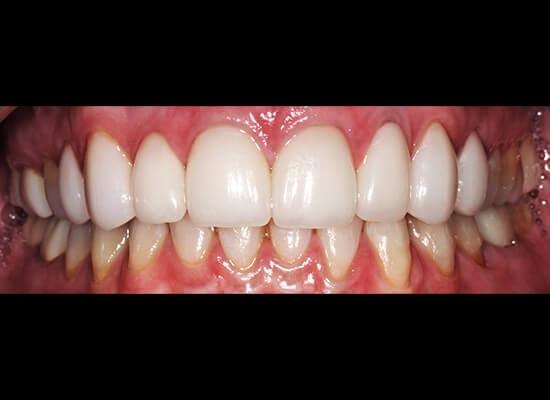La Jolla Cosmetic Dentistry and Orthodontics smile makeover after — San Diego, CA