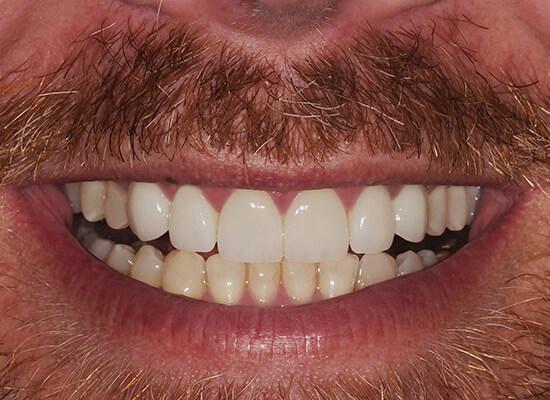 La Jolla Cosmetic Dentistry and Orthodontics invisalign after — San Diego, CA