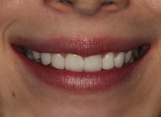 La Jolla Cosmetic Dentistry and Orthodontics invisalign after — San Diego, CA