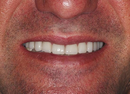 La Jolla Cosmetic Dentistry and Orthodontics invisalign after — San Diego, CA