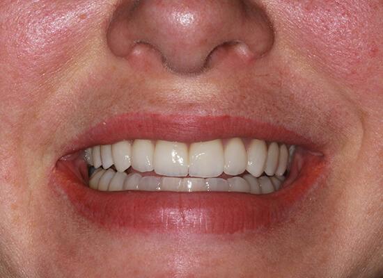 La Jolla Cosmetic Dentistry and Orthodontics invisalign after — San Diego, CA