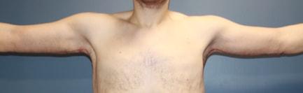 Shay B. Dean, MD arm lift after — Los Angeles, CA
