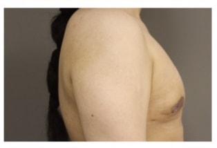 Shay B. Dean, MD gynecomastia after — Los Angeles, CA