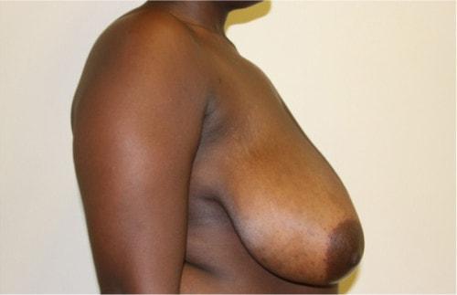 Breast Reduction before at Shay B. Dean, MD in Los Angeles, CA