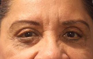 Shay B. Dean, MD eyelid lift after — Los Angeles, CA
