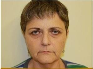Facelift before at Shay B. Dean, MD in Los Angeles, CA