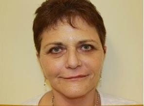 Facelift after at Shay B. Dean, MD in Los Angeles, CA