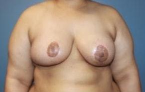 Shay B. Dean, MD breast lift after — Los Angeles, CA