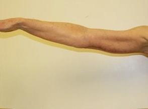 Shay B. Dean, MD arm lift after — Los Angeles, CA