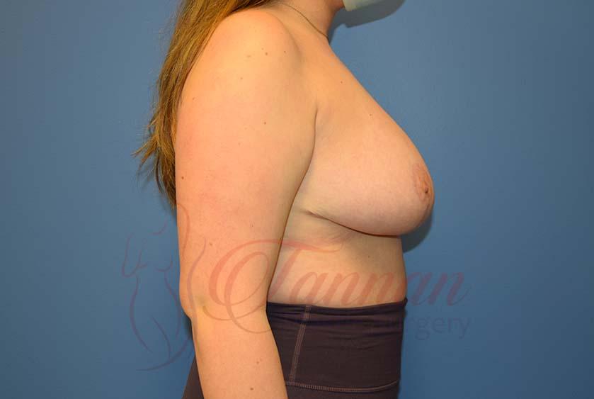 Tannan Plastic Surgery breast augmentation after — Raleigh, NC
