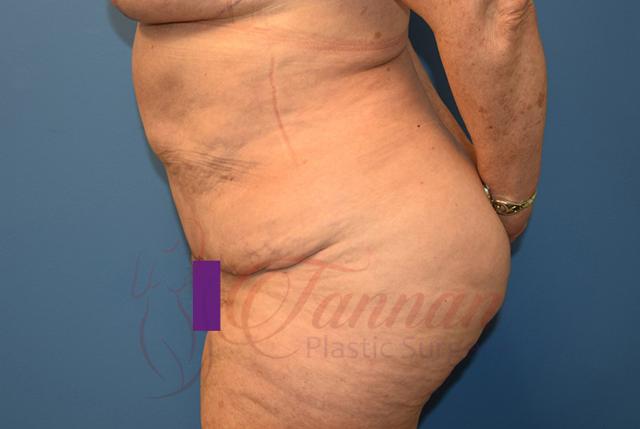 Tummy Tuck after at Tannan Plastic Surgery in Raleigh, NC
