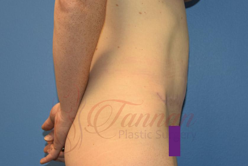 Tannan Plastic Surgery tummy tuck after — Raleigh, NC