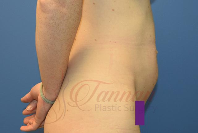 Tummy Tuck before at Tannan Plastic Surgery in Raleigh, NC