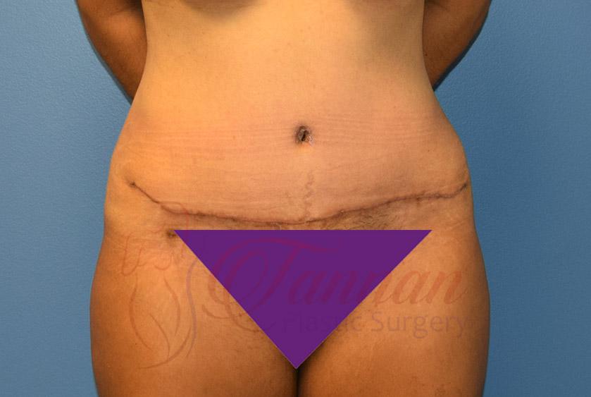 Tannan Plastic Surgery tummy tuck after — Raleigh, NC