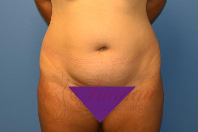 Tummy Tuck before at Tannan Plastic Surgery in Raleigh, NC