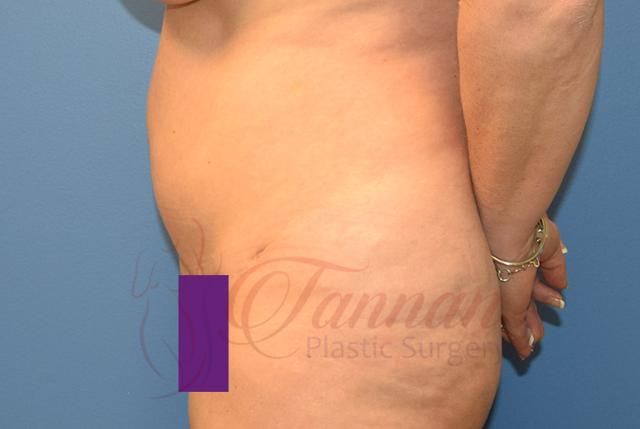 Tummy Tuck after at Tannan Plastic Surgery in Raleigh, NC