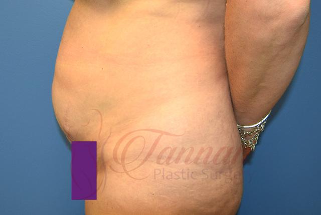 Tummy Tuck before at Tannan Plastic Surgery in Raleigh, NC