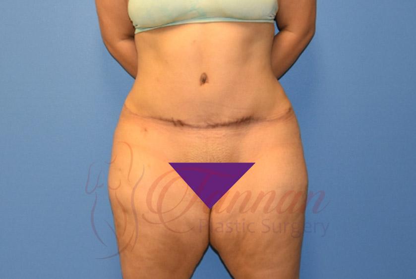 Tannan Plastic Surgery tummy tuck after — Raleigh, NC