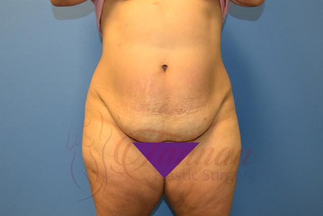 Tummy Tuck before at Tannan Plastic Surgery in Raleigh, NC