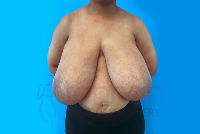 Breast Reduction before at Tannan Plastic Surgery in Raleigh, NC