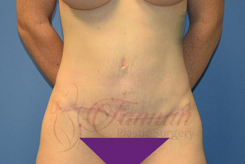 Tannan Plastic Surgery tummy tuck after — Raleigh, NC