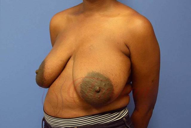 Breast Reduction before at Tannan Plastic Surgery in Raleigh, NC