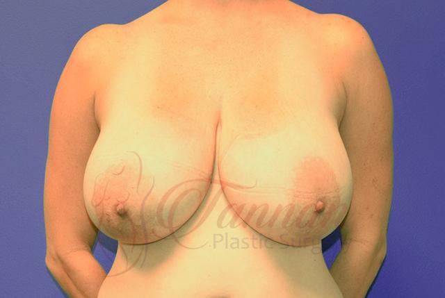 Breast Augmentation before at Tannan Plastic Surgery in Raleigh, NC