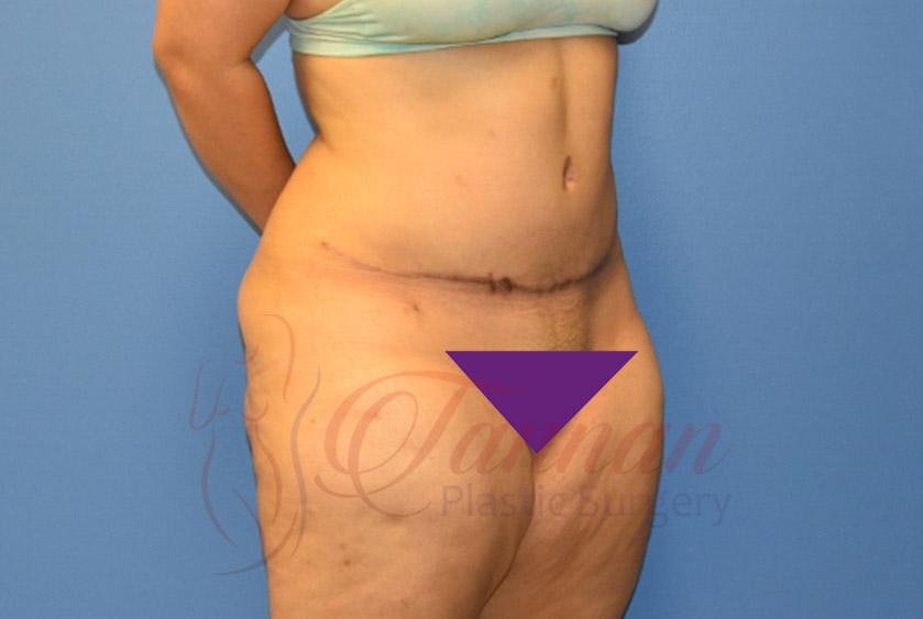 Tannan Plastic Surgery tummy tuck after — Raleigh, NC