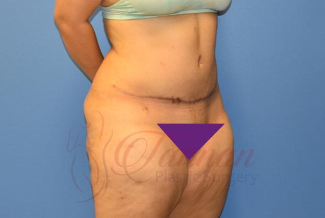 Tummy Tuck after at Tannan Plastic Surgery in Raleigh, NC