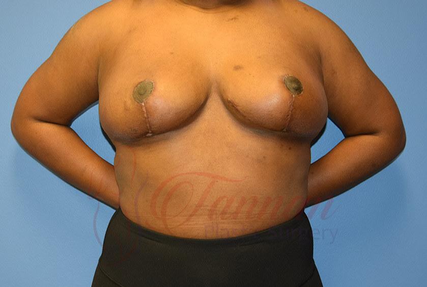 Tannan Plastic Surgery breast augmentation after — Raleigh, NC