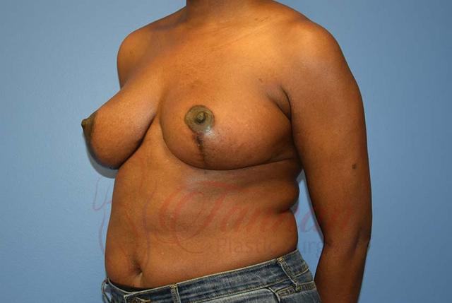 Breast Reduction after at Tannan Plastic Surgery in Raleigh, NC