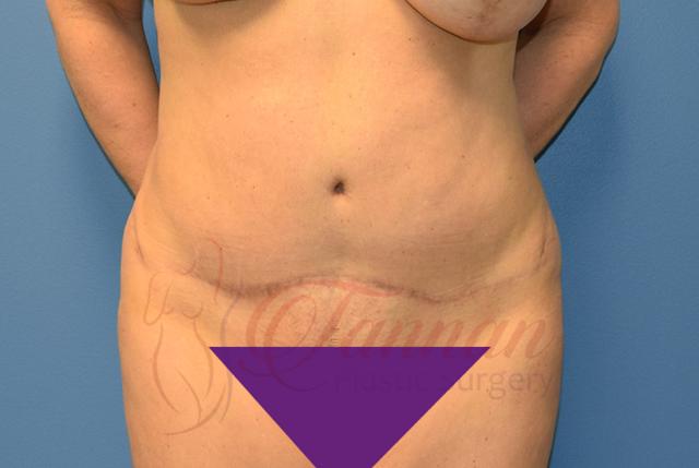 Tummy Tuck after at Tannan Plastic Surgery in Raleigh, NC