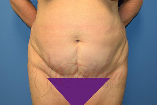 Tummy Tuck before at Tannan Plastic Surgery in Raleigh, NC