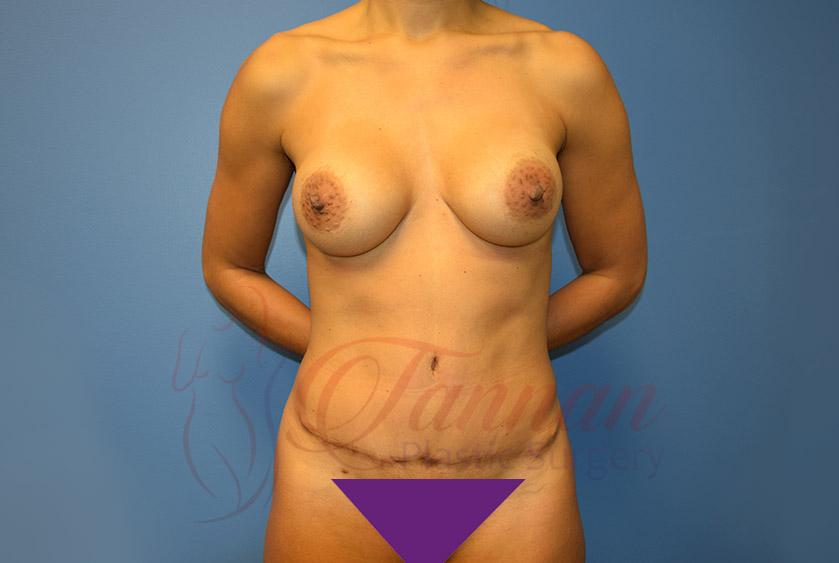 Tannan Plastic Surgery mommy makeover after — Raleigh, NC